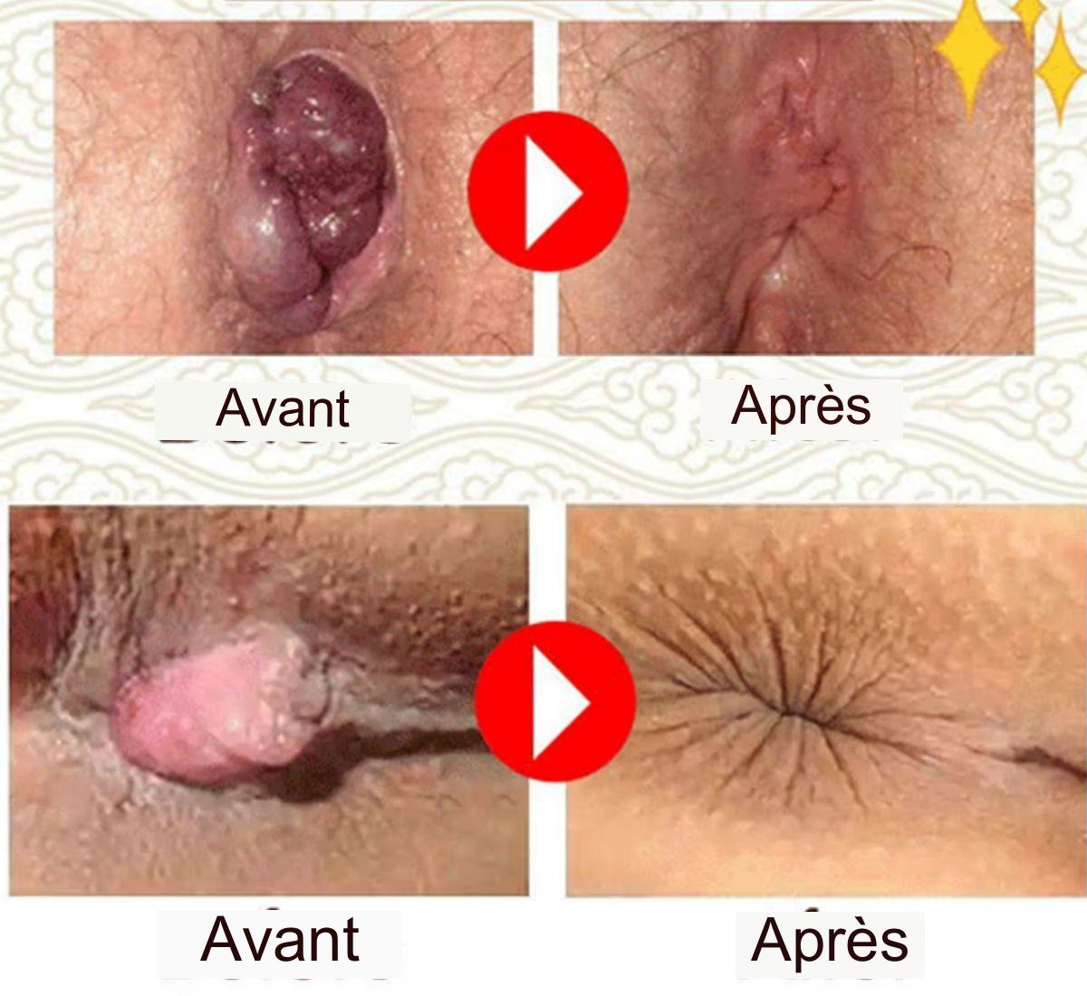 Thé  anti- hémorroïdes à base de plantes naturelle et super efficace